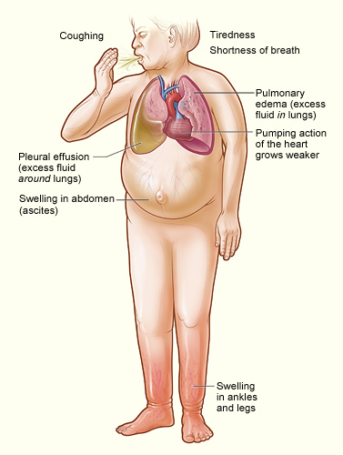 Alcohol And Heart Disease Risk: New Evidence Shows One Drink Is Too Many